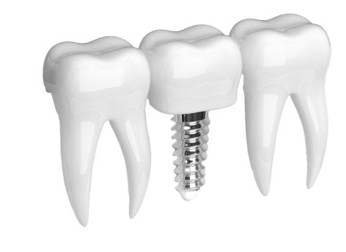 dental implant services in Scottsdale, AZ