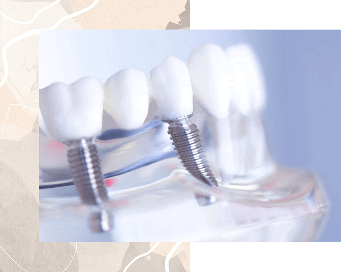 What are Dental Implants