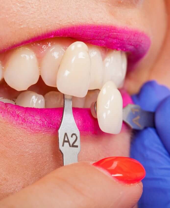 Porcelain Veneers